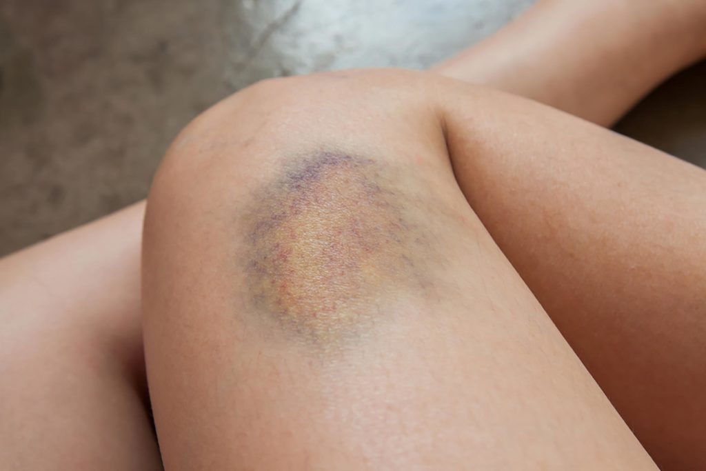 Image result for bruises