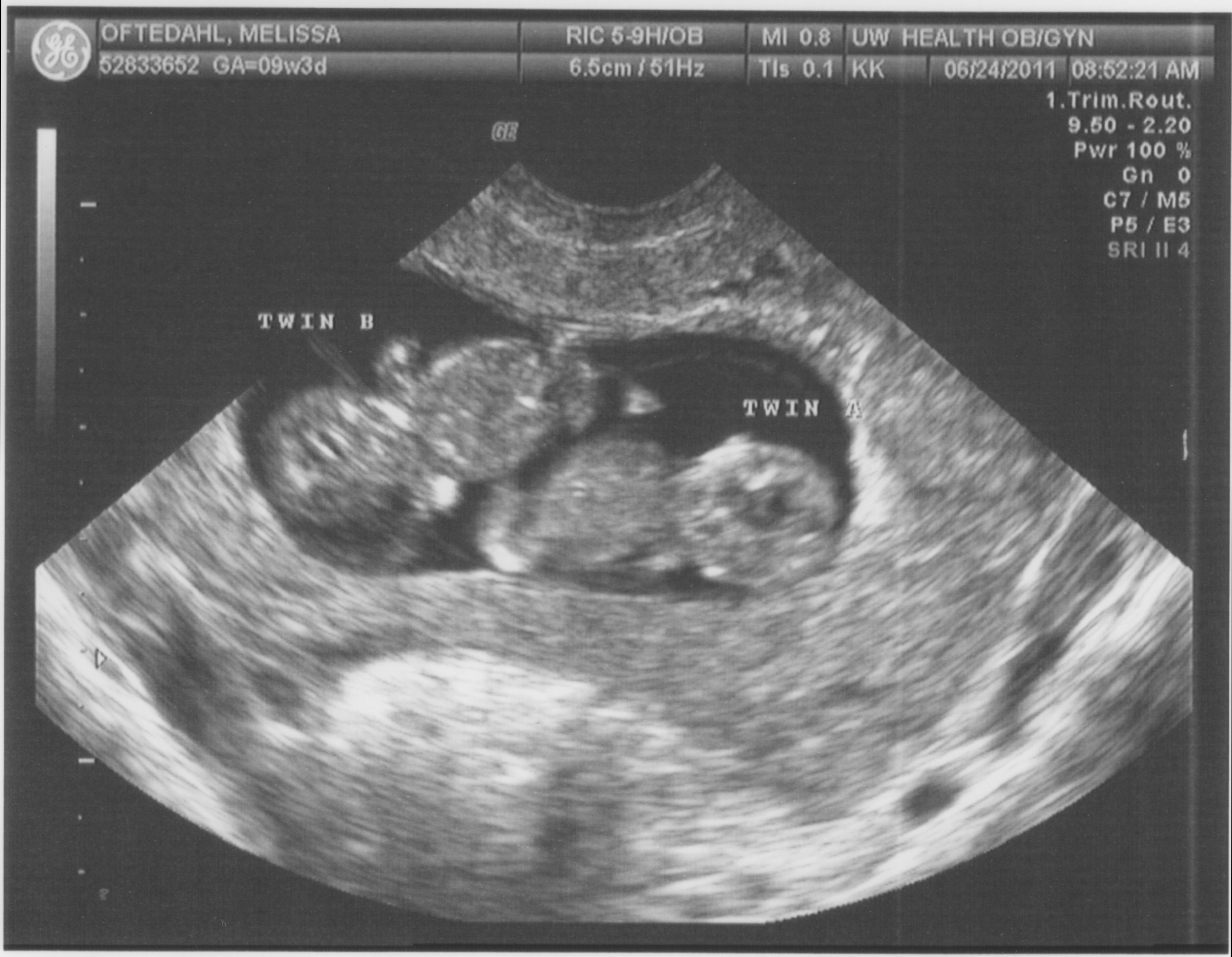12 weeks ultrasound twin 12 Weeks