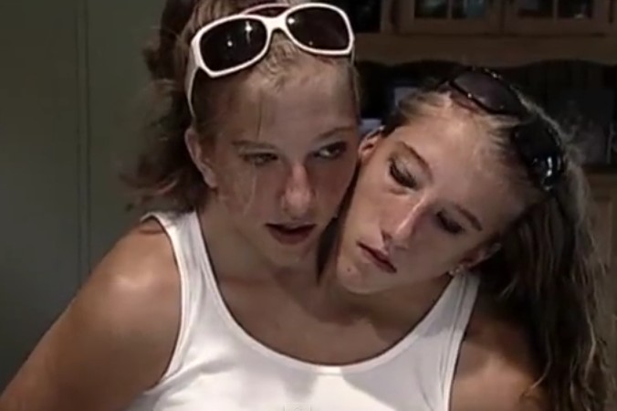 Amazing Facts You Did Not Know About The Most Popular Conjoined Twins Abby And Brittany Page